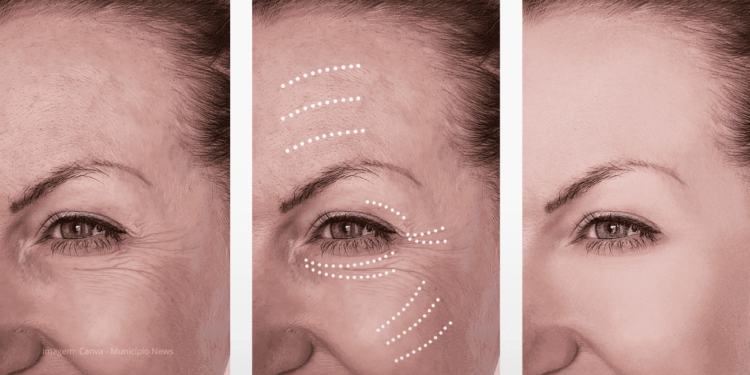 Botulismo Após Botox: O Que a ANVISA Revela Sobre os Riscos que Você Precisa Saber?